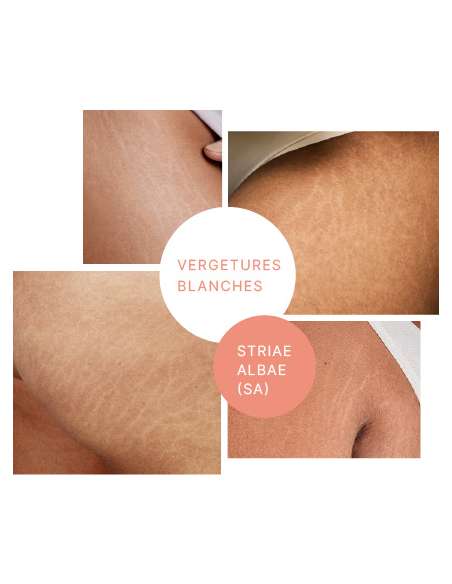 STRIANIX-W Crema 100g