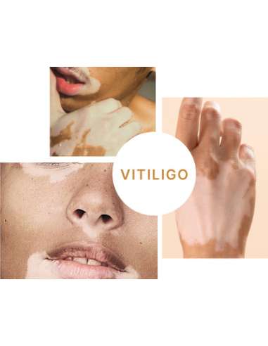 VITILSI Gel