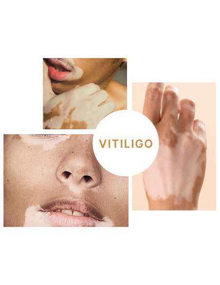 VITILSI Gel