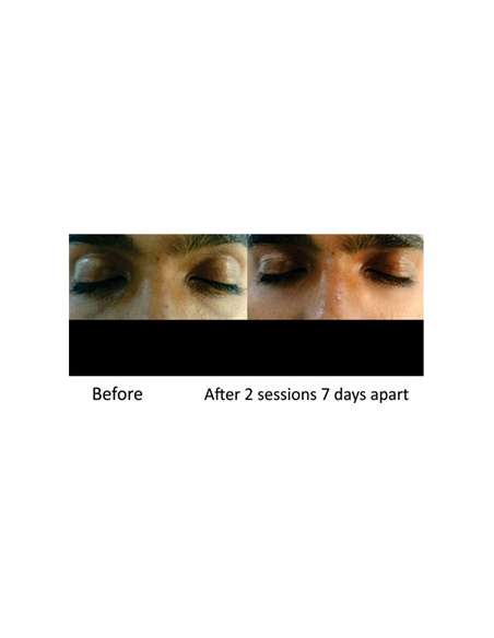 MESOPEEL ARGILAC MESOPEEL ARGILAC