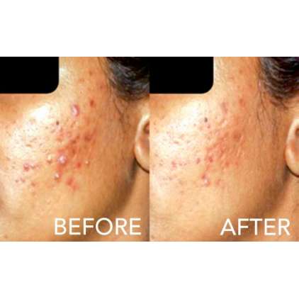 SAMA PEEL - SIMILDIET, peeling anti acné 2