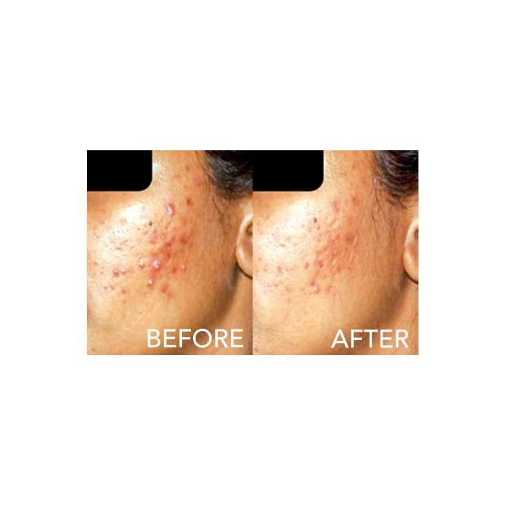 SAMA PEEL - SIMILDIET, peeling anti acné