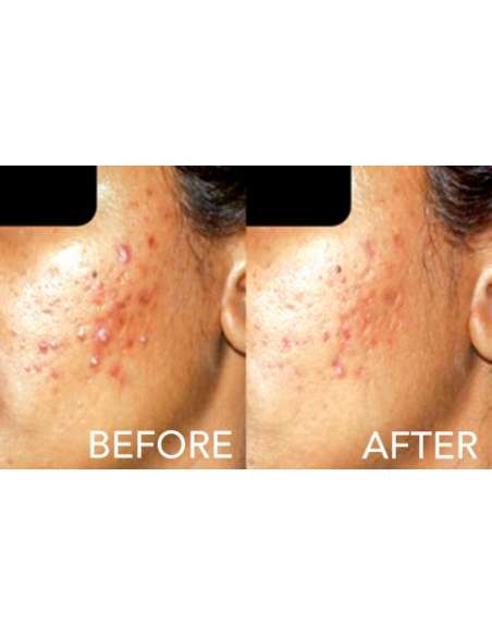 SAMA PEEL - SIMILDIET, peeling anti acné