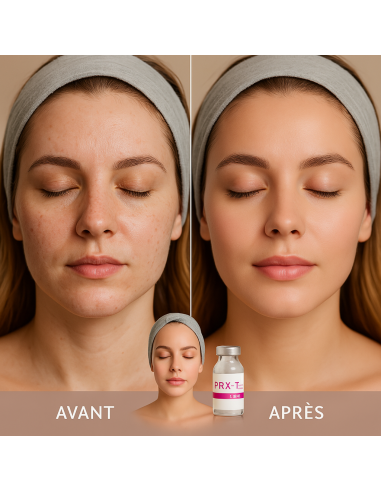 WIQO PRX-T33 Peel 5x4ml – Biorevitalisierendes...