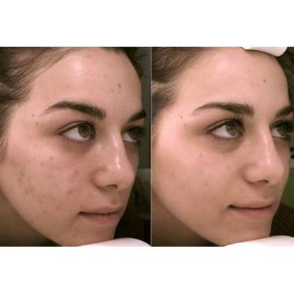 YELLOW PEEL (30ml) - SIMILDIET 2