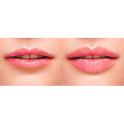 LESTHETIC PARIS dermhage lips 1X1 ml 2