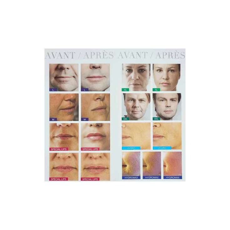 STYLAGE M Lidocaïne (2x1ml) - VIVACY