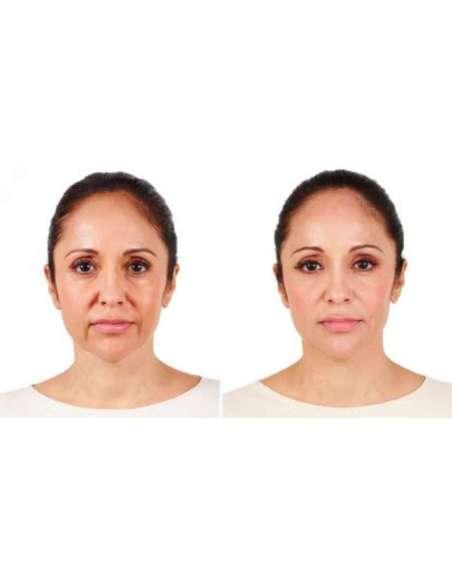 JUVEDERM ULTRA 2 (2x0,55ml)