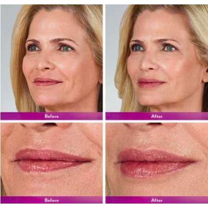 JUVÉDERM® VOLBELLA® con lidocaina 2