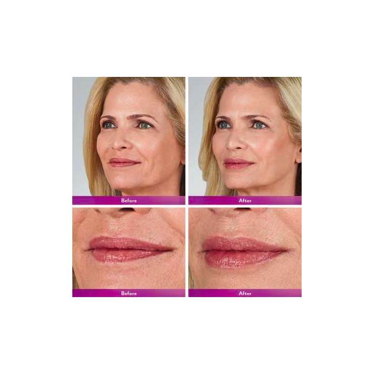 JUVÉDERM® VOLBELLA ® avec Lidocaine