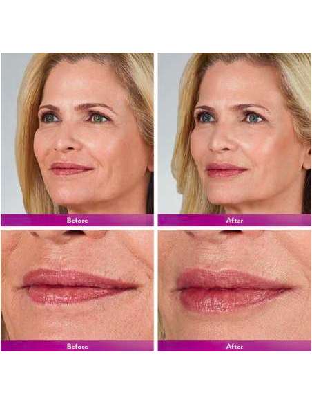 JUVÉDERM® VOLBELLA ® mit Lidocain